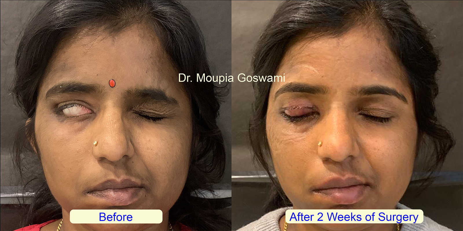 Gold Weight Eyelid Implant Surgery Before and After - Case 2
