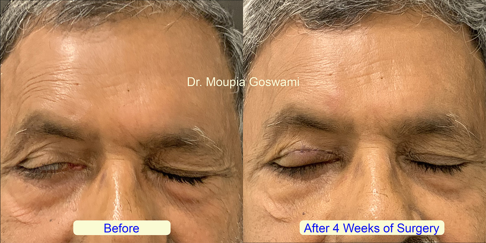 Gold Weight Eyelid Implant Surgery Before and After - Case 4