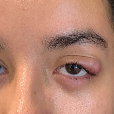Chalazion — painless eyelid lump, photograph 1