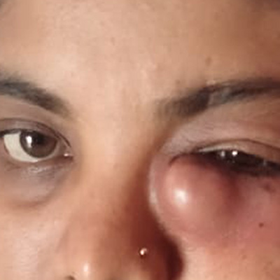 Dacryocystitis — swelling at inner corner of eye, photograph 1