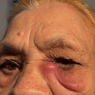 Dacryocystitis — blocked tear duct, photograph 3
