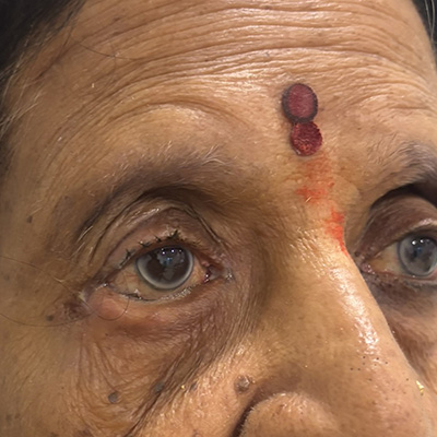Entropion — inward turning eyelid, photograph 1