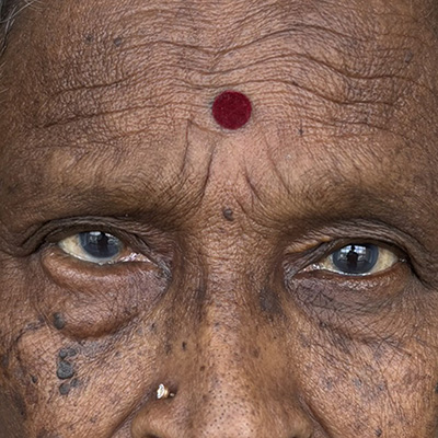 Entropion — inward turning eyelid, photograph 2