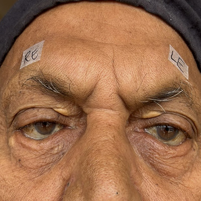 Entropion — inward turning eyelid, photograph 3