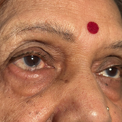 Entropion — inward turning eyelid, photograph 4