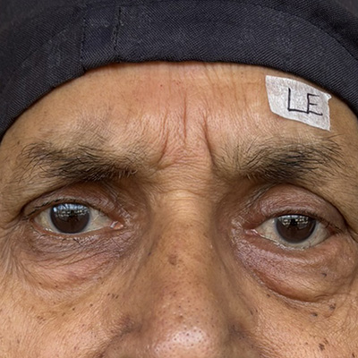 Entropion — inward turning eyelid, photograph 5