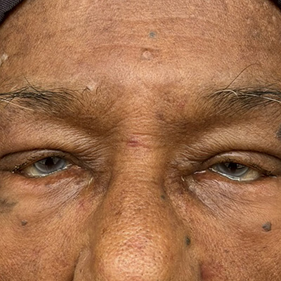 Entropion — inward turning eyelid, photograph 6