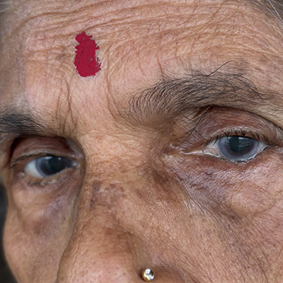 Entropion — inward turning eyelid, photograph 7