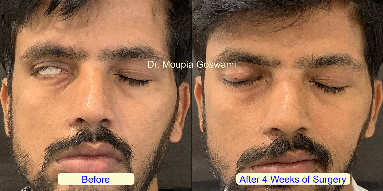 Before and After Gold Weight Surgery for Facial Paralysis — Case 3
