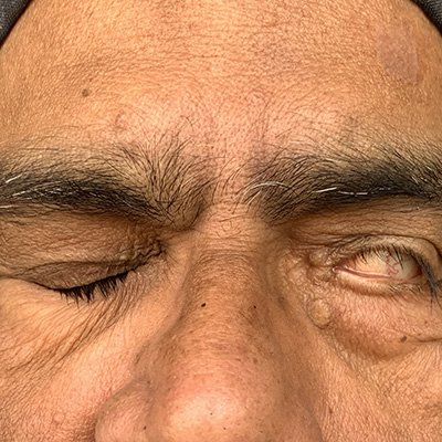 Facial paralysis — eyelid unable to close fully, lagophthalmos, photograph 1