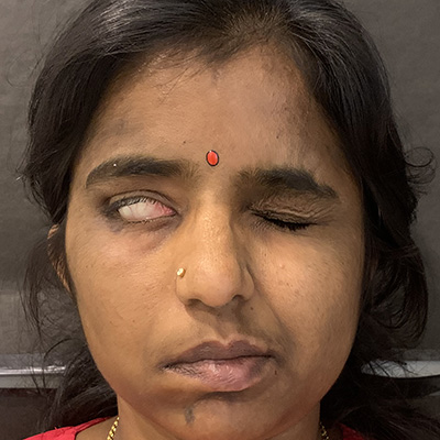 Facial paralysis — corneal exposure from incomplete eyelid closure, photograph 2