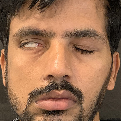 Facial paralysis — eyelid unable to close fully, lagophthalmos, photograph 3
