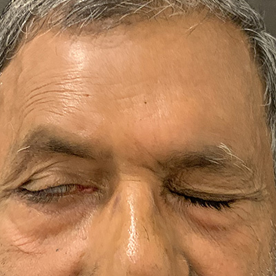 Facial paralysis — corneal exposure from incomplete eyelid closure, photograph 4