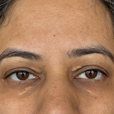 Xanthelasma — yellowish cholesterol deposits on eyelid, photograph 1