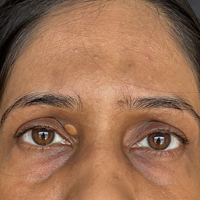 Xanthelasma — yellowish cholesterol deposits on eyelid, photograph 2