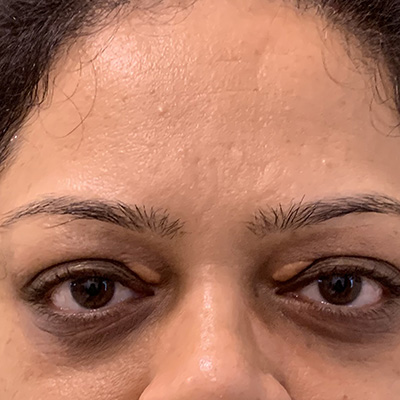 Xanthelasma — yellowish cholesterol deposits on eyelid, photograph 3